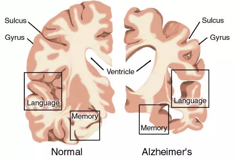 AD药物研发现状：辉瑞、礼来、百健、诺华、强生……